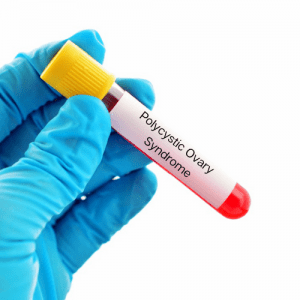 PCOS Blood Test,Polycystic ovary syndrome